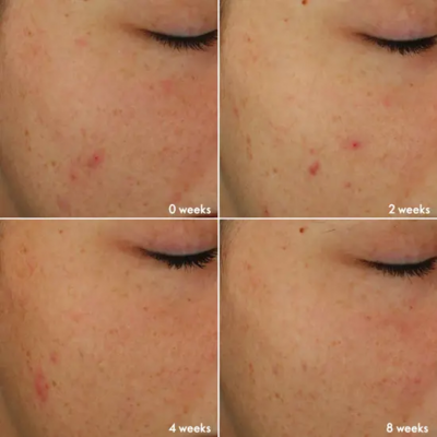 Novage+ Blemish + Age Defy Light -ihonhoitorutiini2.webp